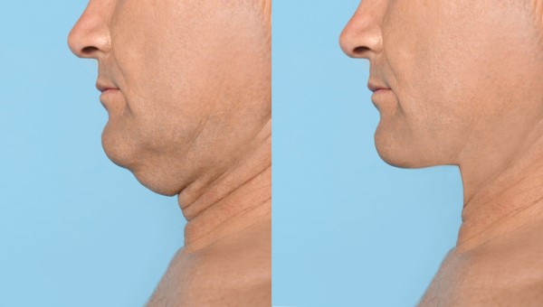 Which Non-Surgical Treatments Work Best for Jowls and Loose Skin Sleaford?
