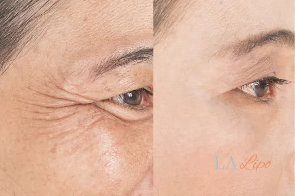 Before and after results of woman - HI-fu wrinkles reduction treatment Sleaford