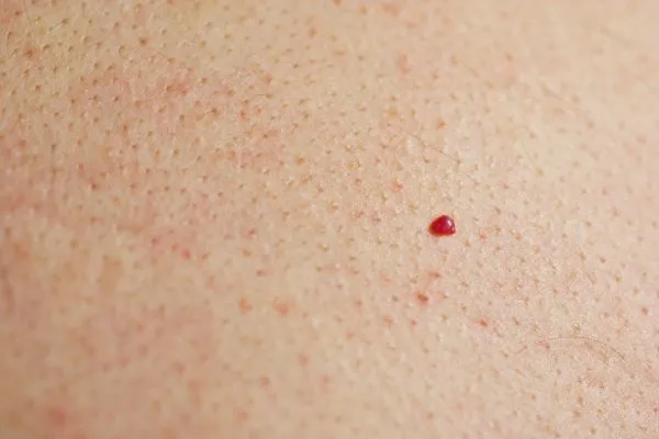close up of a cherry angioma Sleaford