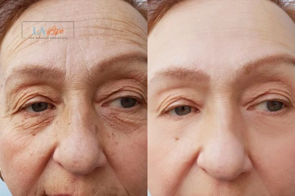 The powerful benefits of Morpheus8 Treatment Sleaford - Call Our team today!