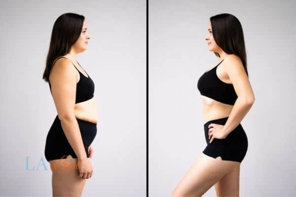 Picture of womans before and after using LA-EMS body sculpting to improve her core strength Sleaford