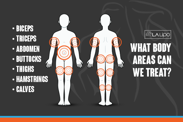Diagram to show areas you can have LA-EMS Body Sculpting Treatment Sleaford