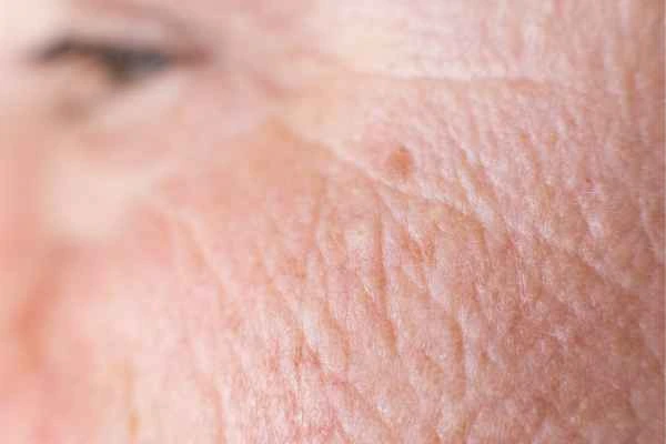 close up picture of a woman's face showing an age spot Sleaford