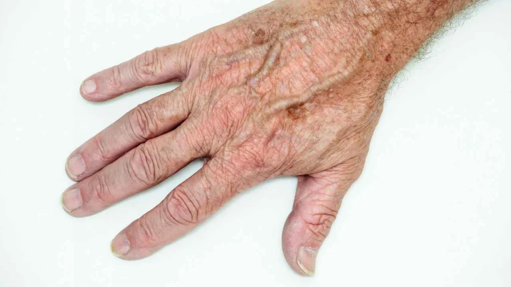 Male hand showing age spot Sleaford