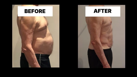 What Symptoms Can Diastasis Recti Cause in Men? Weak Core, Back Pain and Poor Posture Sleaford